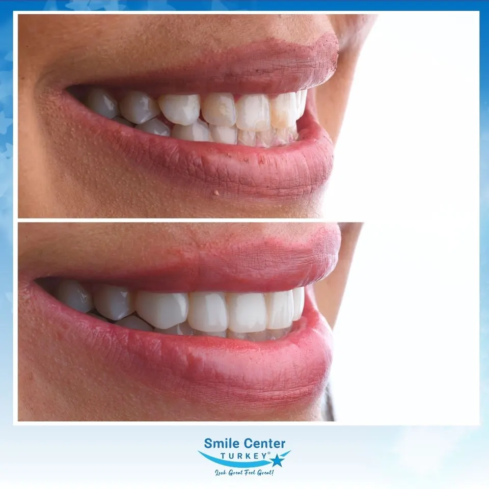 Composite bonding case closing spacing between the upper front teeth