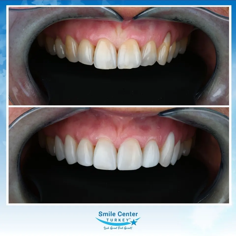 Composite bonding case reshaping worn edges on the upper front teeth