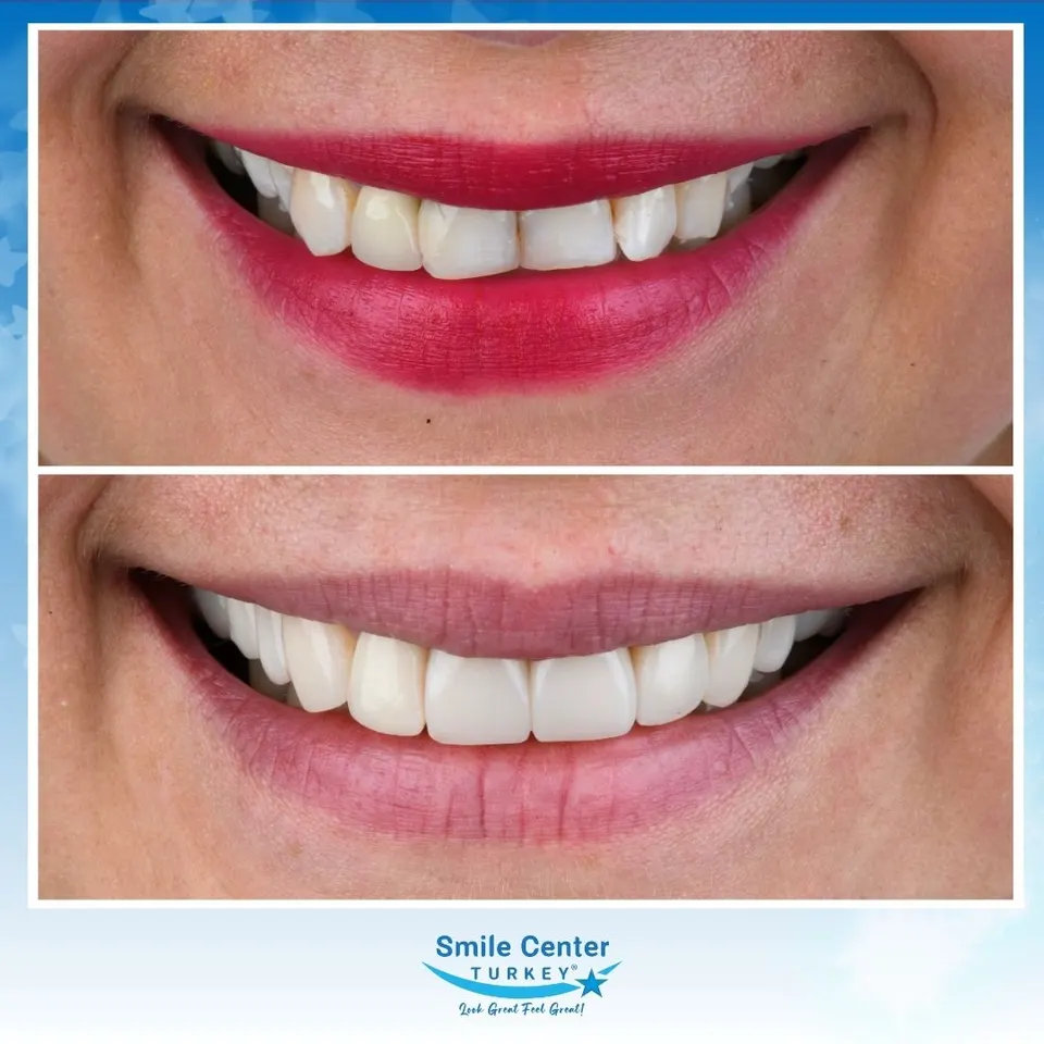 Composite bonding case evening tooth proportions across the smile line