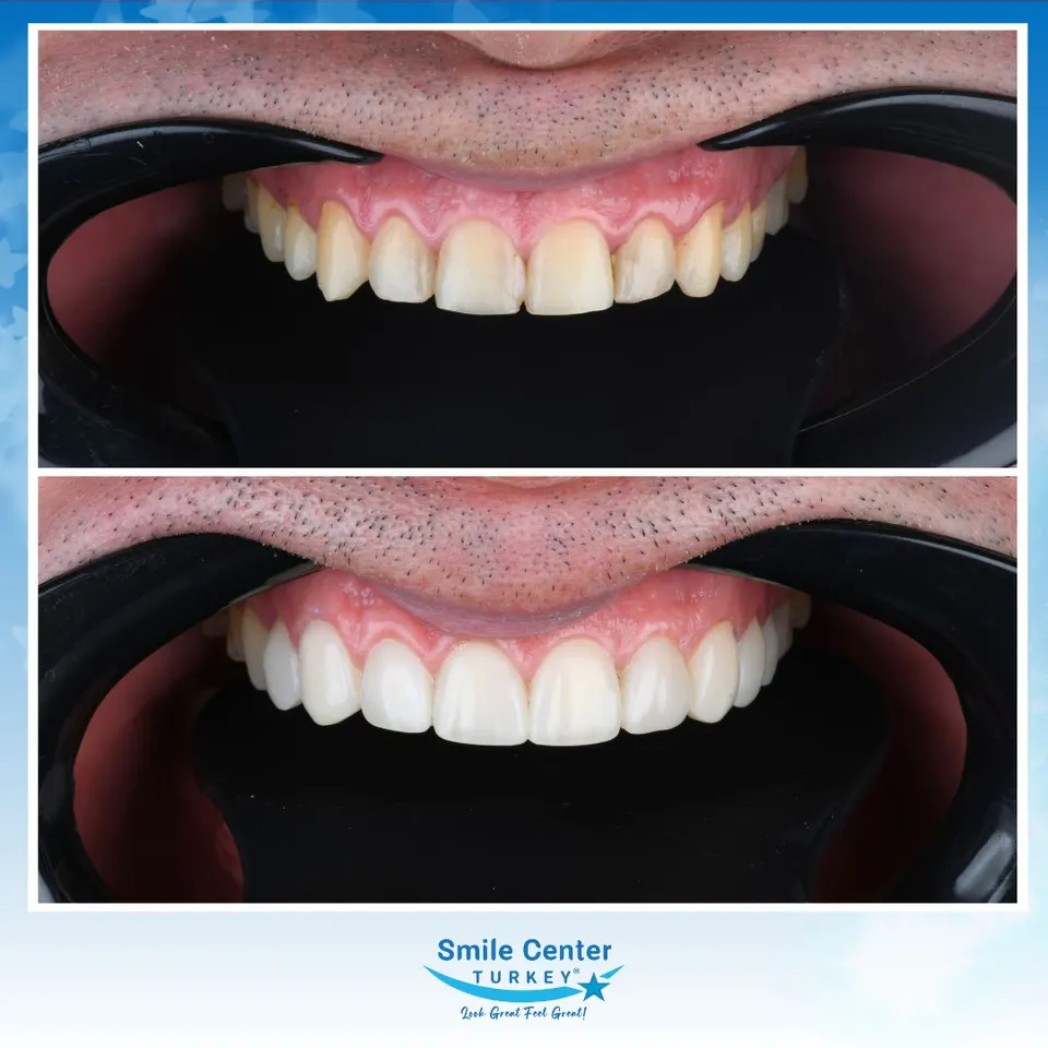 Composite bonding case aligning the appearance of slightly uneven front teeth